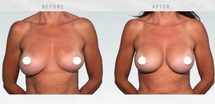 Breast Revision